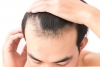Alopecia, caduta dei capelli, uomo