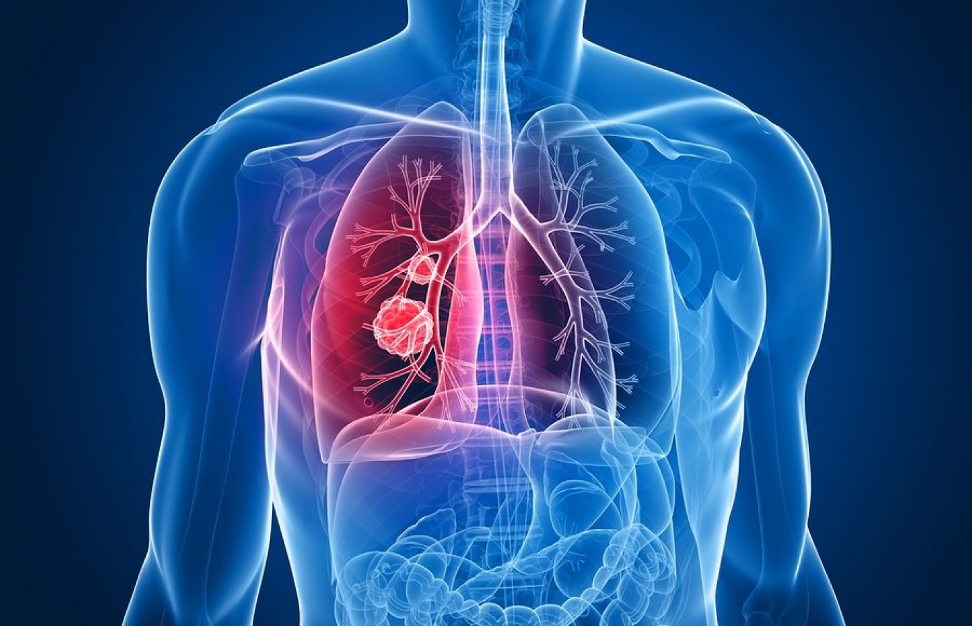 Il Protocollo Pardini nella cura del tumore ai polmoni