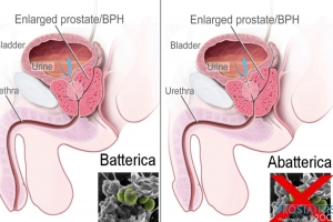 Prostatite abatterica