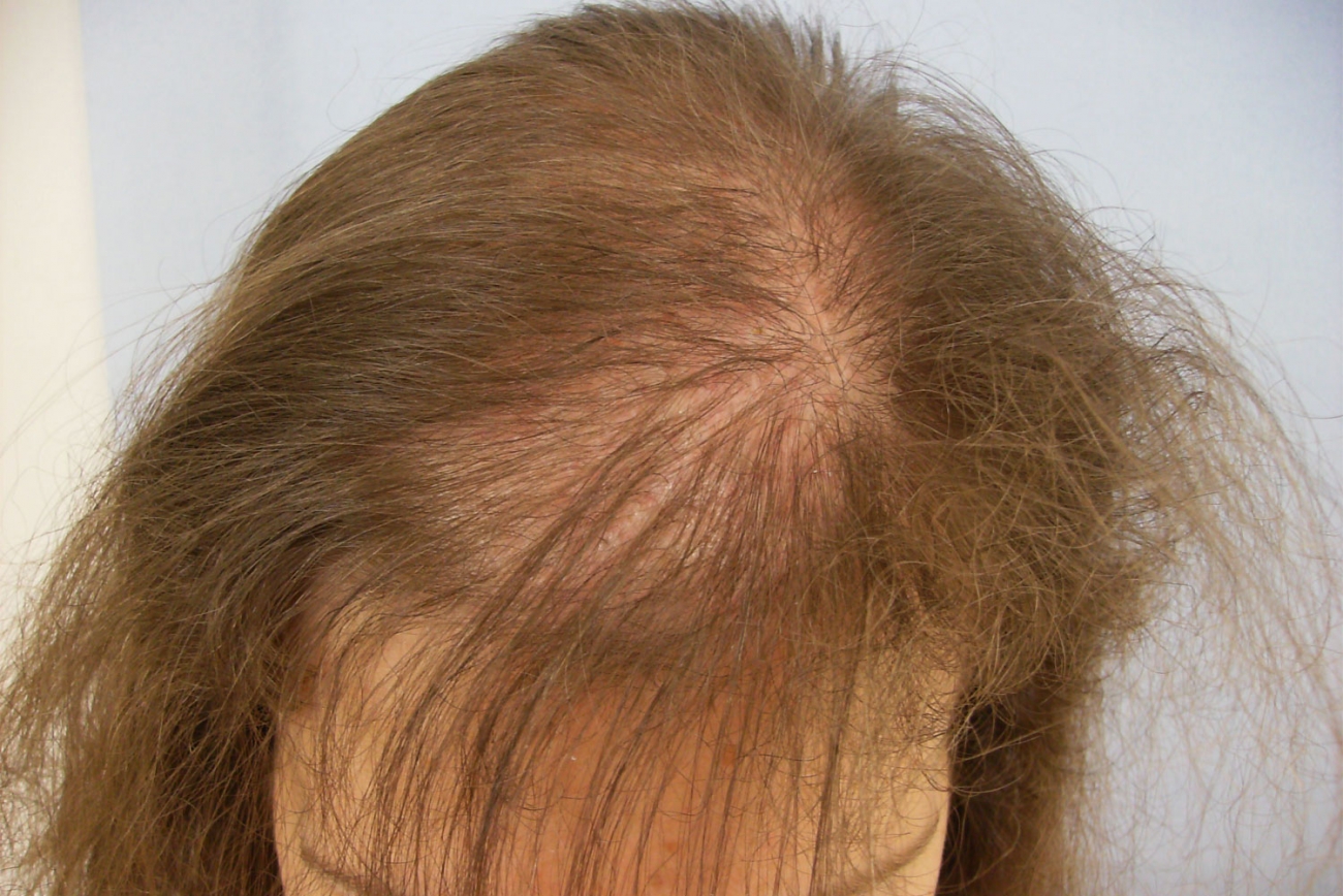 Alopecia androgenetica femminile